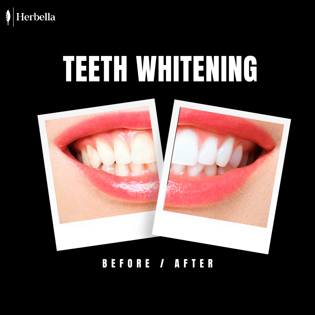 Teeth Whitening - Herbella Organics